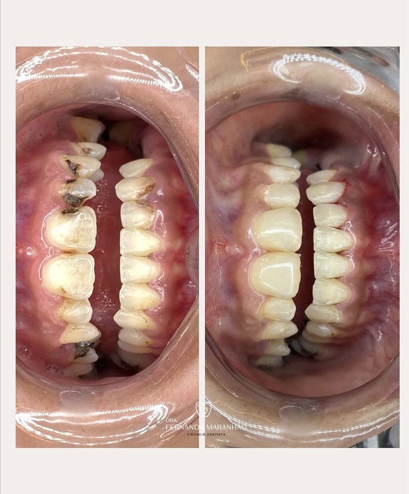 Antes e depois de um tratamento restaurador