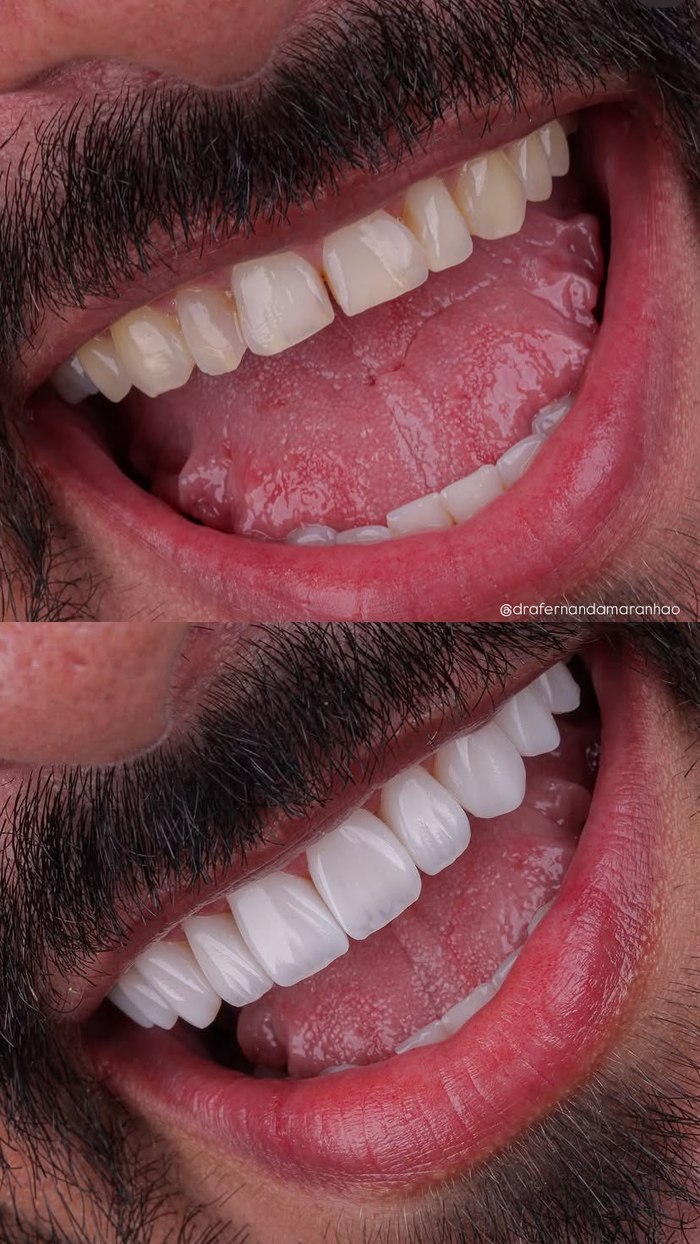 Antes e depois de um tratamento restaurador