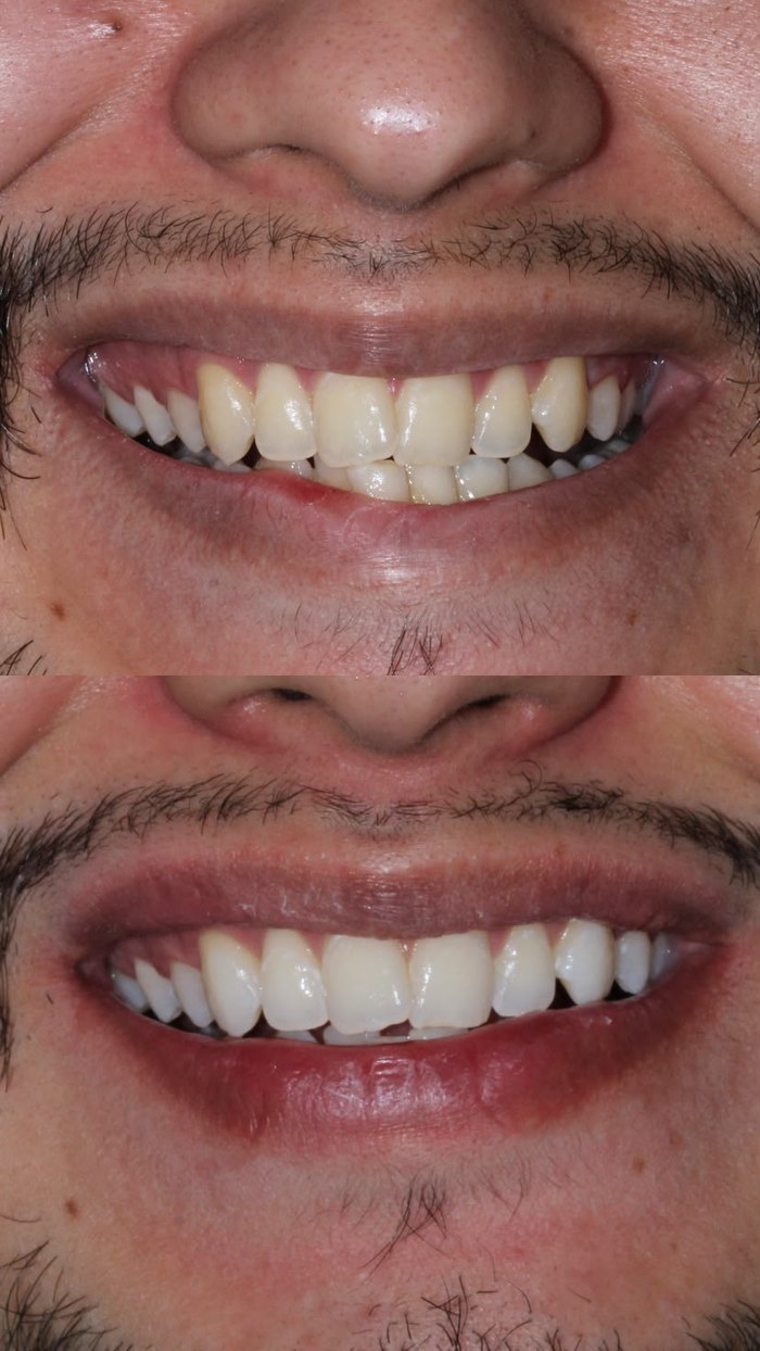 Antes e depois de um tratamento restaurador